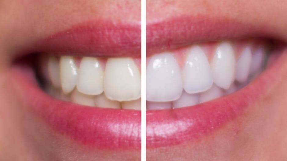 Strisce sbiancanti dentali Pro Teeth Whitening