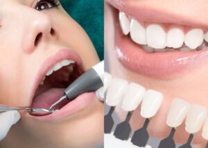 Differenza tra pulizia e sbiancamento dei denti